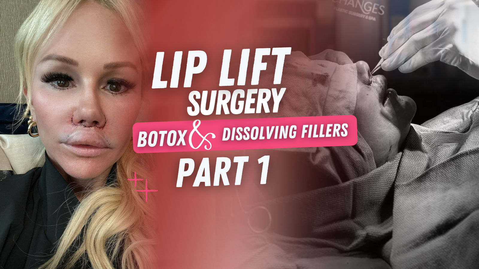 My Lip Lift Surgery: Part 1